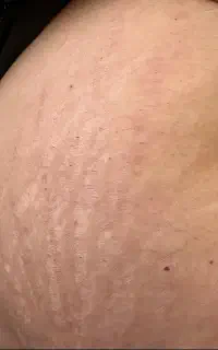 جای بخیه. زخم.جوش پاک کردن تاتو