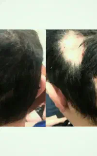 درمان مشکلات ریزش سکه‌ ای (الوپسی)