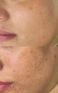 برطرف شدن لک های بارداری
