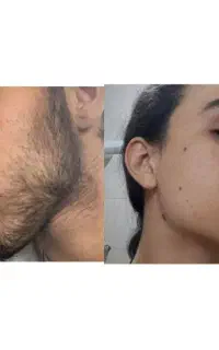 راهکار تخصصی کم پشتی ریش