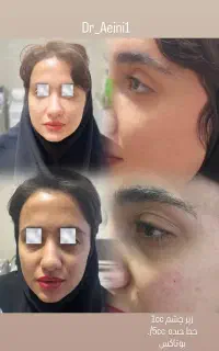 لیزر فیلر بوتاکس چربی