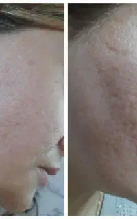 مزوتراپی و PRP / صورت ، دست و گردن