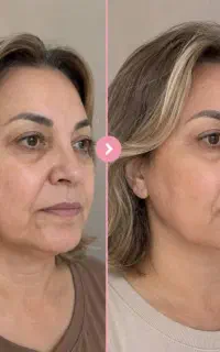 کرم بوتاکس تضمینی