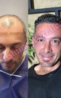 کاشت مو شیراز در تبریز اذربایجان شرقی