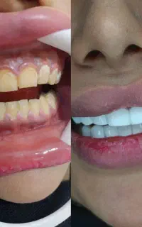 تخفیف ویژه خدمات کامپوزیت لبه شیشه ای و بلیچینگ