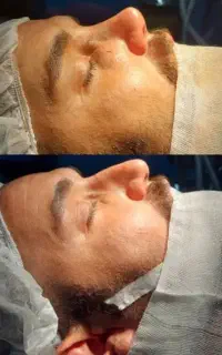 عمل بینی استخوانی و گوشتی اقساطی فقط با ماهی 3تومن