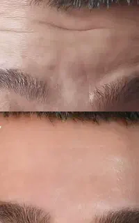 ژل و بوتاکس