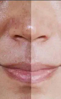 مزو تراپی برای روشن سازی پوست۱/۵۰۰