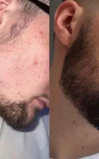 رویش کامل با این سرم