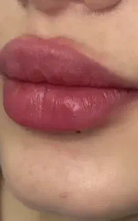 ژل لب، بوتاکس ،فیلر صورت ،پی ارپی ،مزو صورت