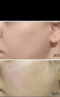 پوست کره ای ومزونیدلینگ با کوکتل های تخصصی