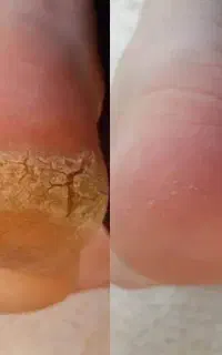 پدیکور درمانی پا