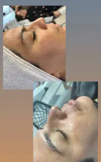 ۵۰٪ تخفیف پاییزه پاکسازی تخخصی پوست فیلر بوتاکس