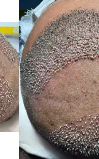 تخفیف ویژه کاشت مو و ابرو با تراکم بالا وطبیعی