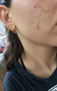 «پاکسازی پوست و تخلیه جوش سرسیاه+ مشاوره رایگان»