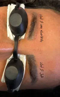 پاک کردن تتو با لیزر کیوسوییچ تضمینی