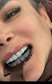 تخفیف ویژه کامپوزیت، روکش ...