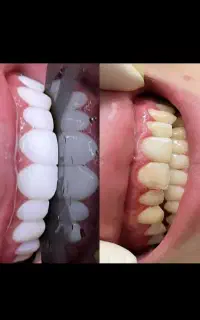 جشنواره کامپوزیت دندان فکی۱۶م تومانvipدرمحل زیباجو