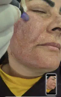 میکرونیدلینگ پوست صورت (دکتر علی بابایی)