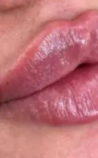 فیلر و بوتاکس وجوانساز