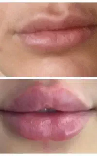 آفر ویژه  فیلربدن صورت  بوتاکس  فشیال پیرسینگ