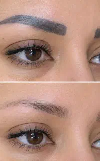 پاک کردن تتو های سیاه و رنگی ..پاکسازی وکربن تراپی