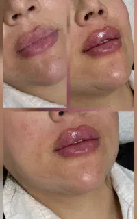 لیزرموهای زائد،ژل وبوتاکس،پی آرپی و کربوکسی .دالیا