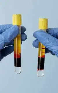 prp پ ار پی prf مزوتراپی جای جوش مو صورت