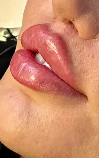 کلینیک تخصصی فیلر لب با تکنیک M روسی عروسکی باربی