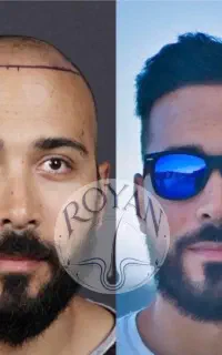کاشت مو ۲۲ کاشت ابرو ۱۵