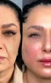 ساکشن شکم و پهلو در مرکز زیبایی روجا