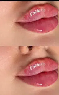 خدمات تزریق ژل لب گونه چونه زاویه فک ۱۲۰۰