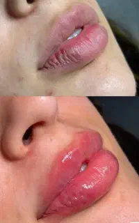 تزریق ژل و بوتاکس با قیمت استثنایی/ژل 890بوتاکس750