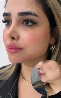 تزریق ژل فول فیس ژل لب و لیفت با نخ