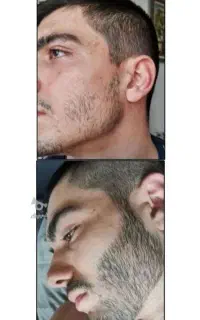 پر پشتی رویش تضمینی