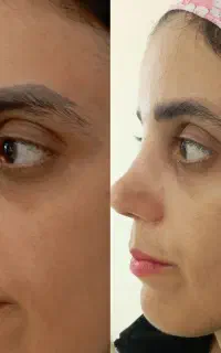 لیزرکیوسوییچ(پاک کردن تتوخط چشم وابرو صورت و بدن )
