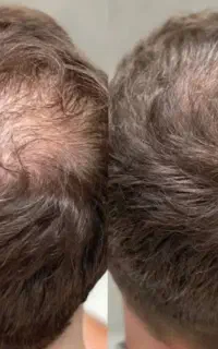 تخفیف پی ار پی prp درمان ریزش مو هفتصد هزار تومان