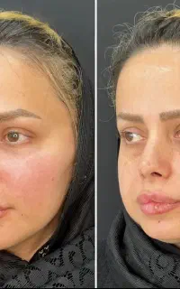 ژل سی سی۱۵۰۰ تومان ، آنزیم۱۵۰۰، بوتاکس۱۵۰۰ پزشک