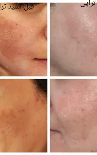 پاکسازی تخصصی پوست و مو و هایفو و خالبرداری