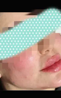 ژل و بوتاکس  تخفیف به مدت  ده روز