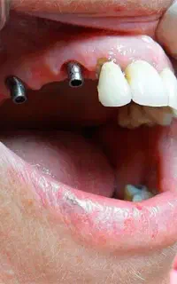 مرکزفوق تخصصی ایمپلنت دیجیتال مشهد/سبک کاخ لبخند