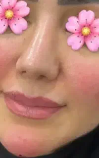 آف ویژه ژل و بوتاکس و مزو