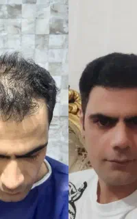 کاشت مو فول تراکم وی ای پی شیرازی