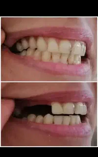 دندانسازی مروارید  جنس ژاپنی 20 میلیون