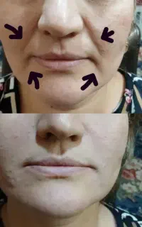 بوتاکس فیلر صورت بادی مزوتراپی پی آرپی لیفت نخ مطب
