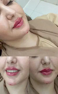off20%اخر فصل تزریق ژل و بوتاکس توسط پزشک (چکی)