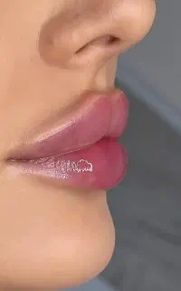 ژل بوتاکس فیلر زاویه سازی خط لبخند لیزر مطب پزشک