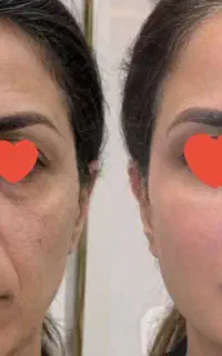 خدمات تخصصی ژل،فیلر،بوتاکس.میکروبلیدینگ ابرو