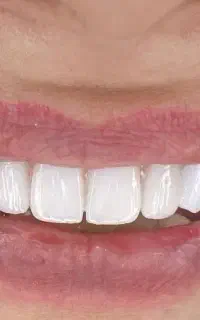 تخفیف ویژه 50درصدی ایمپلنت دندان 11تومن