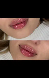 ژل وبوتاکس فقط ۴۳۰ با 1 ccژل بوتاکس هدیه بگیر